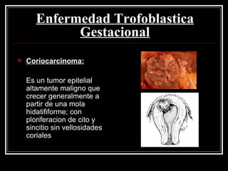 Enfermedad Trofoblastica Gestacional Coriocarcinoma: Es un tumor epitelial altamente maligno que crecer generalmente a partir de una mola hidatififorme; con ploriferacion de cito y sincitio sin vellosidades coriales  