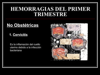 HEMORRAGIAS DEL PRIMER TRIMESTRE No Obstétricas 1.  Cervicitis Es la inflamación del cuello uterino debido a la infección bacteriana 