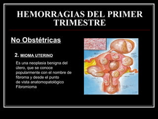 HEMORRAGIAS DEL PRIMER TRIMESTRE No Obstétricas 2.  MIOMA UTERINO Es una neoplasia benigna del útero, que se conoce popularmente con el nombre de fibroma y desde el punto de vista anatomopatológico Fibromioma 