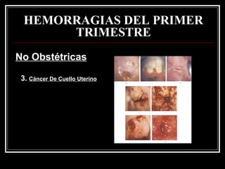 HEMORRAGIAS DEL PRIMER TRIMESTRE No Obstétricas 3.  Cáncer De Cuello Uterino 