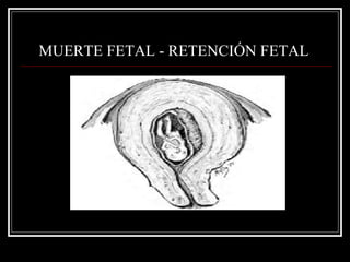 MUERTE FETAL - RETENCIÓN FETAL   