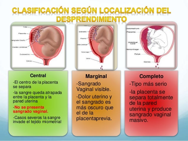 Hemorragias En La Segunda Mitad Del Embarazo