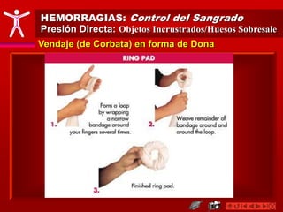 Vendaje (de Corbata) en forma de Dona
HEMORRAGIAS: Control del Sangrado
Presión Directa: Objetos Incrustrados/Huesos Sobresale
 