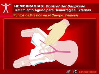 HEMORRAGIAS: Control del Sangrado
Tratamiento Agudo para Hemorragias Externas
Puntos de Presión en el Cuerpo: Femoral
 