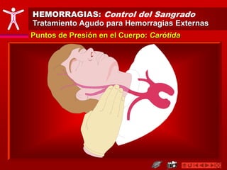 HEMORRAGIAS: Control del Sangrado
Tratamiento Agudo para Hemorragias Externas
Puntos de Presión en el Cuerpo: Carótida
 