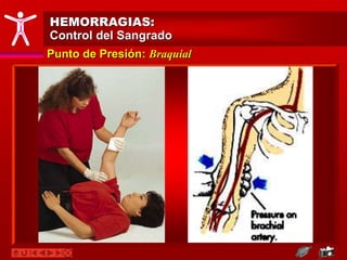Punto de Presión: Braquial
HEMORRAGIAS:
Control del Sangrado
 