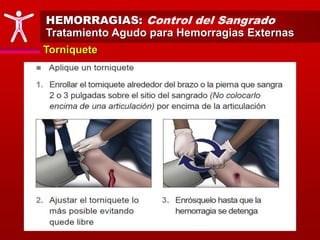 HEMORRAGIAS: Control del Sangrado
Tratamiento Agudo para Hemorragias Externas
Torniquete
 
