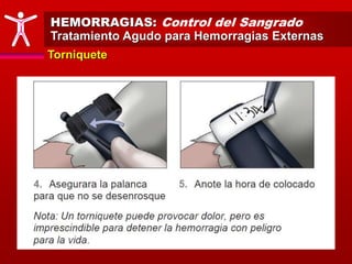 HEMORRAGIAS: Control del Sangrado
Tratamiento Agudo para Hemorragias Externas
Torniquete
 