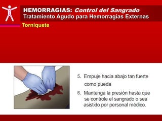 HEMORRAGIAS: Control del Sangrado
Tratamiento Agudo para Hemorragias Externas
Torniquete
 