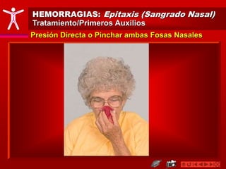 HEMORRAGIAS: Epitaxis (Sangrado Nasal)
Tratamiento/Primeros Auxilios
Presión Directa o Pinchar ambas Fosas Nasales
 