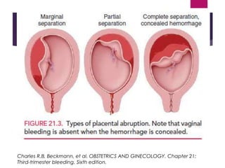 Charles R.B. Beckmann, et al. OBSTETRICS AND GINECOLOGY. Chapter 21:
Third-trimester bleeding. Sixth edition.
 