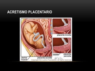ACRETISMO PLACENTARIO
• Penetración placentaria anormal dentro de la pared uterina debido a la ausencia de la
capa de Nita...
