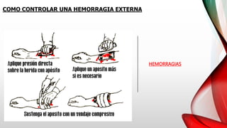 HEMORRAGIAS
COMO CONTROLAR UNA HEMORRAGIA EXTERNA
 