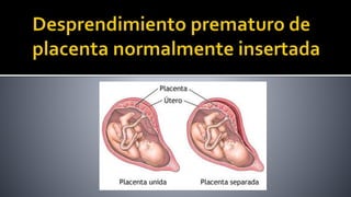  Después de las 20 semanas se conoce como:
 DPPNI
 Abruptio placentae
 Accidente de Baudelocque
 Puede tener consecue...