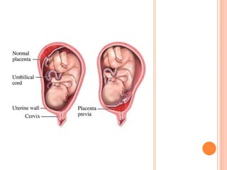 PLACENTA PREVIA
 Definición: Implantación de la placenta sobre el
orificio cervical interno
 Parcial Total

 Marginal:...