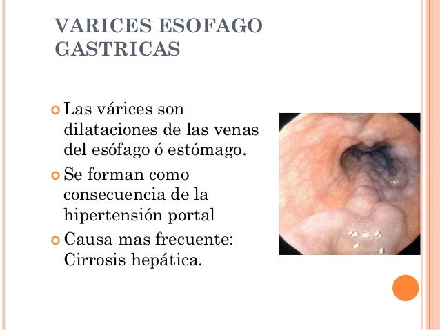 El tratamiento varikoza por el láser en kislovodske