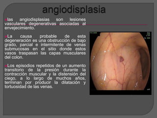 las angiodisplasias son lesiones 
vasculares degenerativas asociadas al 
envejecimiento. 
La causa probable de esta 
degeneración es una obstrucción de bajo 
grado, parcial e intermitente de venas 
submucosas en el sitio donde estos 
vasos traspasan las capas musculares 
del colon. 
Los episodios repetidos de un aumento 
transitorio de la presión durante la 
contracción muscular y la distensión del 
ciego, a lo largo de muchos años, 
terminan por producir la dilatación y 
tortuosidad de las venas. 
 