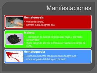 Hematemesis 
• vomito de sangre. 
• siempre indica sangrado alto. 
Melena 
• : Eliminación de material fecal de color negro y olor fétido 
característico 
• Indica sangrado alto por lo menos un volumen de sangre de 
50mL. 
Hematoquecia 
• Deposición de heces sanguinolentas o sangre pura 
• indica sangrado distal al alguno de treitz. 
 