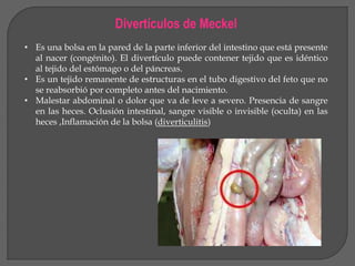 Divertículos de Meckel 
• Es una bolsa en la pared de la parte inferior del intestino que está presente 
al nacer (congénito). El divertículo puede contener tejido que es idéntico 
al tejido del estómago o del páncreas. 
• Es un tejido remanente de estructuras en el tubo digestivo del feto que no 
se reabsorbió por completo antes del nacimiento. 
• Malestar abdominal o dolor que va de leve a severo. Presencia de sangre 
en las heces. Oclusión intestinal, sangre visible o invisible (oculta) en las 
heces ,Inflamación de la bolsa (diverticulitis) 
 