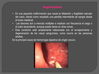 Angiodisplasia 
• Es una pequeña malformación que causa la dilatación y fragilidad vascular 
del colon, dando como resultado una pérdida intermitente de sangre desde 
el tracto intestinal. 
• Las lesiones son a menudo múltiples e implican con frecuencia el ciego o 
el colon ascendente, aunque puede darse en otras zonas. 
• Esta condición está ampliamente relacionada con el envejecimiento y 
degeneración de los vasos sanguíneos, como ocurre en las personas 
adultas. 
Es la principal causa de hemorragia digestiva de origen oscuro. 
 