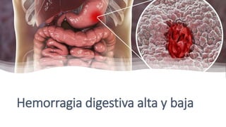 Hemorragia digestiva alta y baja
 
