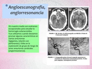 *


    •En nuestro medio son exámenes
    excepcionales para estudiar la
    hemorragia subaracnoidea.
    •Los utilizamos cuando deseamos
    precisar algunas características en
    ciertos aneurismas
    •(gigantes, relación con
    perforantes). Útiles en la
    exploración de grupo de riesgo de
    tener aneurismas cerebrales
    (angiorresonancia).
 