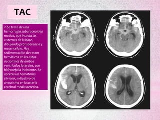 TAC
Se trata de una
hemorragia subaracnoidea
masiva, que inunda las
cisternas de la base,
dibujando protuberancia y
mesencéfalo. Hay
sedimentación de restos
hemáticos en las astas
occipitales de ambos
ventrículos laterales, con
hidrocefalia incipiente. Se
aprecia un hematoma
silviano, indicativo de
aneurisma en la arteria
cerebral media derecha.
 