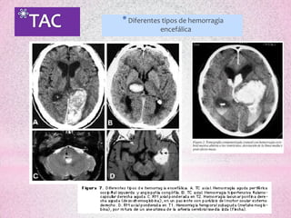 * Diferentes tipos de hemorragia
            encefálica
 