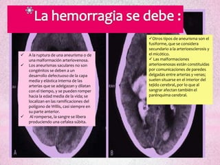 Otros tipos de aneurisma son el
                                          fusiforme, que se considera
                                          secundario a la arterioesclerosis y
   A la ruptura de una aneurisma o de    el micótico.
    una malformación arteriovenosa.        Las malformaciones
   Los aneurismas saculares no son       arteriovenosas están constituidas
    congénitos se deben a un              por comunicaciones de paredes
    desarrollo defectuoso de la capa      delgadas entre arterias y venas;
    media y elástica interna de las       suelen situarse en el interior del
    arterias que se adelgazan y dilatan   tejido cerebral, por lo que al
    con el tiempo, y se pueden romper     sangrar afectan también el
    hacia la edad media de la vida; se    parénquima cerebral.
    localizan en las ramificaciones del
    polígono de Willis, casi siempre en
    su parte anterior.
    Al romperse, la sangre se libera
    produciendo una cefalea súbita.
 