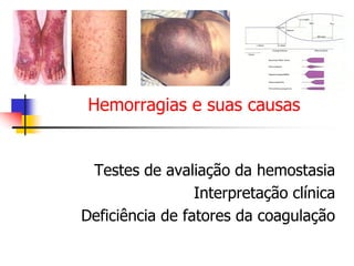 Hemorragias e suas causas


 Testes de avaliação da hemostasia
                 Interpretação clínica
Deficiência de fatores da coagulação
 