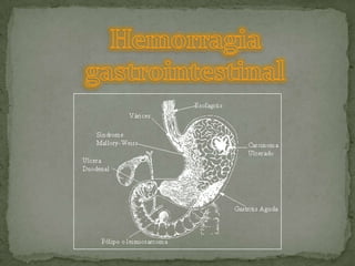 Hemorragia gastrointestinal 
