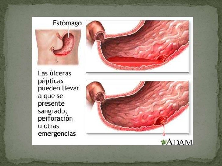 Se ha inflamado la vena en el pie que hacer la foto