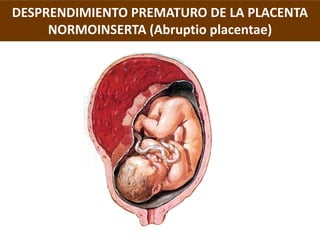 DESPRENDIMIENTO PREMATURO DE LA PLACENTA
     NORMOINSERTA (Abruptio placentae)

Puede ser:
   - Total
   - Parcial
Dos gr...