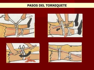 PASOS DEL TORNIQUETE 