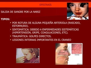 EPISTAXIS SALIDA DE SANGRE POR LA NARIZ TIPOS: POR ROTURA DE ALGUNA PEQUEÑA ARTERIOLA (RASCADO, ESTORNUDO). SINTOMÁTICA: DEBIDO A ENFERMEDADES SISTEMÁTICAS (HIPERTENSIÓN, GRIPE, COAGULACIONES, ETC). TRAUMÁTICA: GOLPES DIRECTOS. LESIONES INTERNAS IMPORTANTES EN EL CRANEO 