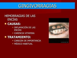 GINGIVORRAGIAS HEMORRAGIAS DE LAS ENCÍAS CAUSAS: INFLAMACIÓN DE LAS ENCÍAS CARENCIA VITAMINA TRATAMIENTO: CARECEN DE IMPORTANCIA MÉDICO HABITUAL 