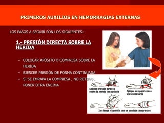 PRIMEROS AUXILIOS EN HEMORRAGIAS EXTERNAS   LOS PASOS A SEGUIR SON LOS SIGUIENTES: 1.- PRESIÓN DIRECTA SOBRE LA HERIDA COLOCAR APÓSITO O COMPRESA SOBRE LA HERIDA EJERCER PRESIÓN DE FORMA CONTINUADA SI SE EMPAPA LA COMPRESA , NO RETIRAR, PONER OTRA ENCIMA 