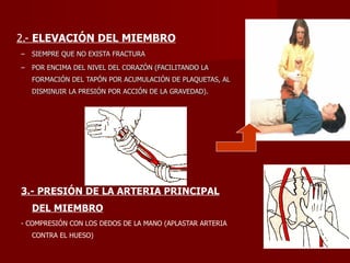 2.-  ELEVACIÓN DEL MIEMBRO SIEMPRE QUE NO EXISTA FRACTURA POR ENCIMA DEL NIVEL DEL CORAZÓN (FACILITANDO LA FORMACIÓN DEL TAPÓN POR ACUMULACIÓN DE PLAQUETAS, AL DISMINUIR LA PRESIÓN POR ACCIÓN DE LA GRAVEDAD). 3.- PRESIÓN DE LA ARTERIA PRINCIPAL DEL MIEMBRO - COMPRESIÓN CON LOS DEDOS DE LA MANO (APLASTAR ARTERIA CONTRA EL HUESO) 