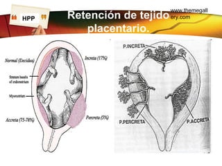 www.themegall
ery.comLOGO Retención de tejido
placentario.
HPP
 