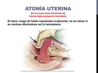 ATONÍA UTERINA
Sobredistención
uterina
Fatiga del
musculo uterino
Trabajo de parto
prolongado o
precipitado
Medicamentos
u...
