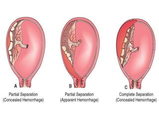  Trombofilias adquiridas o heredadas
 Anomalías vasculares
 Leiomiomas uterinos. (detrás de la
implantación placentaria...