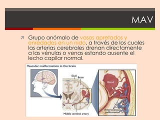 MAV
 Grupo anómalo de vasos apretados y
  enredados en un nido, a través de los cuales
  las arterias cerebrales drenan directamente
  a las vénulas o venas estando ausente el
  lecho capilar normal.
 