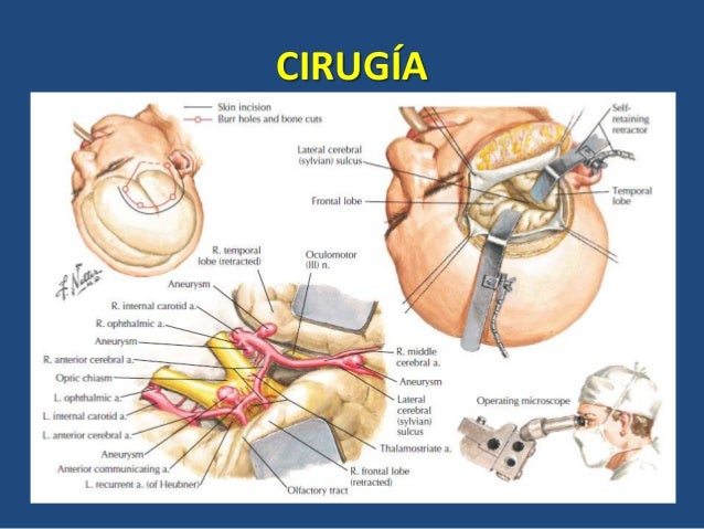 LA CIRUGIA
Se emplea para aislar obstruir o reforzar las paredes de la arteria debilitada reduce el riesgo de que mas adelant