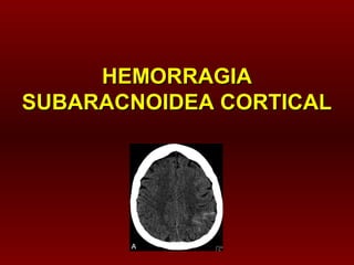 HEMORRAGIA
SUBARACNOIDEA CORTICAL

 