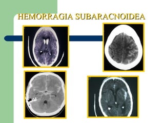 HEMORRAGIA SUBARACNOIDEAHEMORRAGIA SUBARACNOIDEA
 
