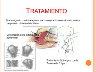 TRATAMIENTO
Si el sangrado continúa a pesar del manejo arriba mencionado realice
compresión bimanual del útero.

Compresión de la arteria aorta
abdominal

Tratamiento Quirurgico con la
Tecnica de B Lynch

 