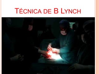 TÉCNICA DE B LYNCH

 