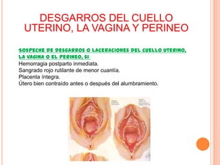 DESGARROS DEL CUELLO
UTERINO, LA VAGINA Y PERINEO
Sospeche de desgarros o laceraciones del cuello uterino,
la vagina o el perineo, si:
Hemorragia postparto inmediata.
Sangrado rojo rutilante de menor cuantía.
Placenta íntegra.
Útero bien contraído antes o después del alumbramiento.

 