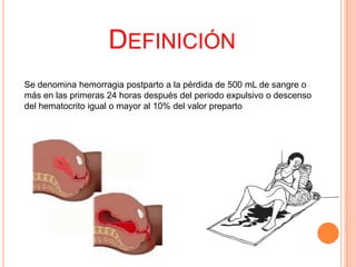 DEFINICIÓN
Se denomina hemorragia postparto a la pérdida de 500 mL de sangre o
más en las primeras 24 horas después del periodo expulsivo o descenso
del hematocrito igual o mayor al 10% del valor preparto

 
