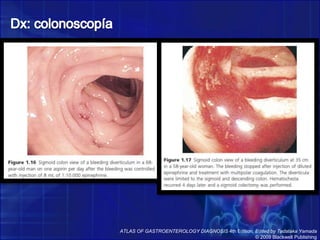Dx: colonoscopíaATLAS OF GASTROENTEROLOGY DIAGNOSIS 4th Edition, Edited by Tadataka Yamada© 2009 Blackwell Publishing